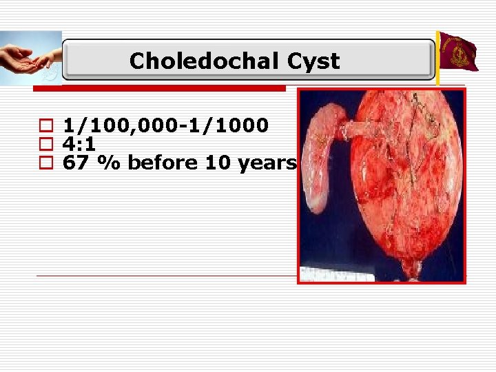 Choledochal Cyst o 1/100, 000 -1/1000 o 4: 1 o 67 % before 10