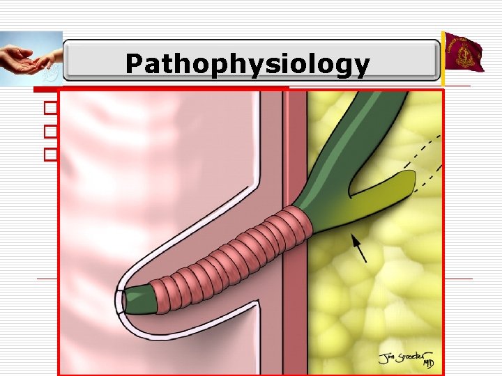 Pathophysiology o PBMU o Weakness of CBD o Obstruction 