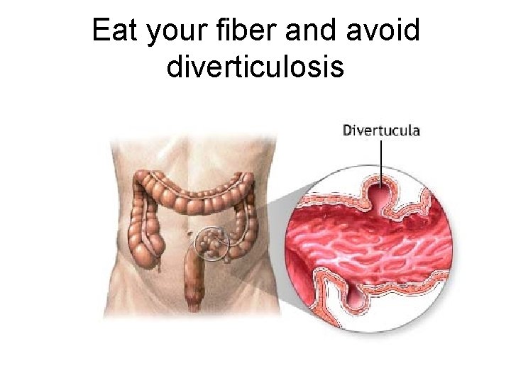 Eat your fiber and avoid diverticulosis 