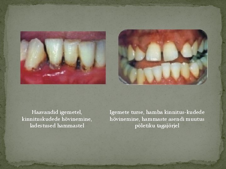 Haavandid igemetel, kinnituskudede hõvinemine, ladestused hammastel Igemete turse, hamba kinnitus-kudede hõvinemine, hammaste asendi muutus