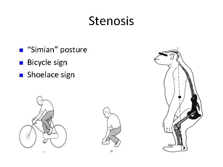 Stenosis n n n “Simian” posture Bicycle sign Shoelace sign 