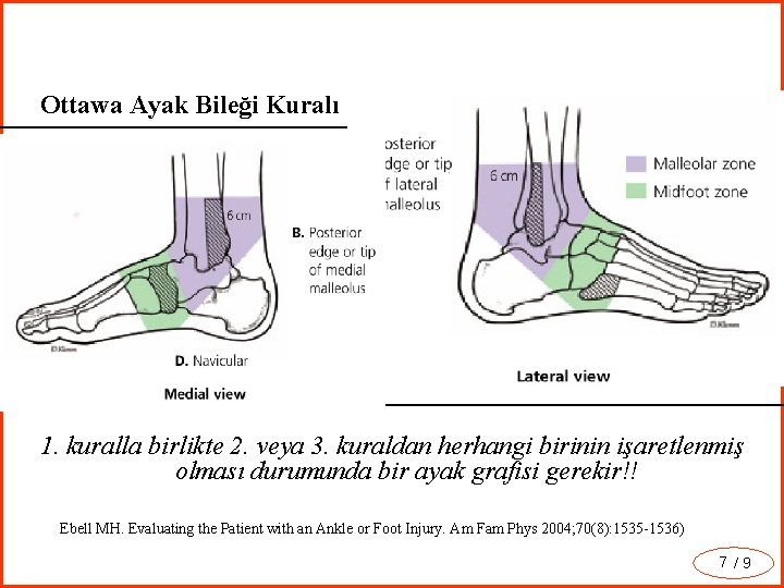 Ottawa Ayak Bileği Kuralı Ottawa Ayak Kuralı 1. ٱ Malleol civarında ağrı (Şekilde A