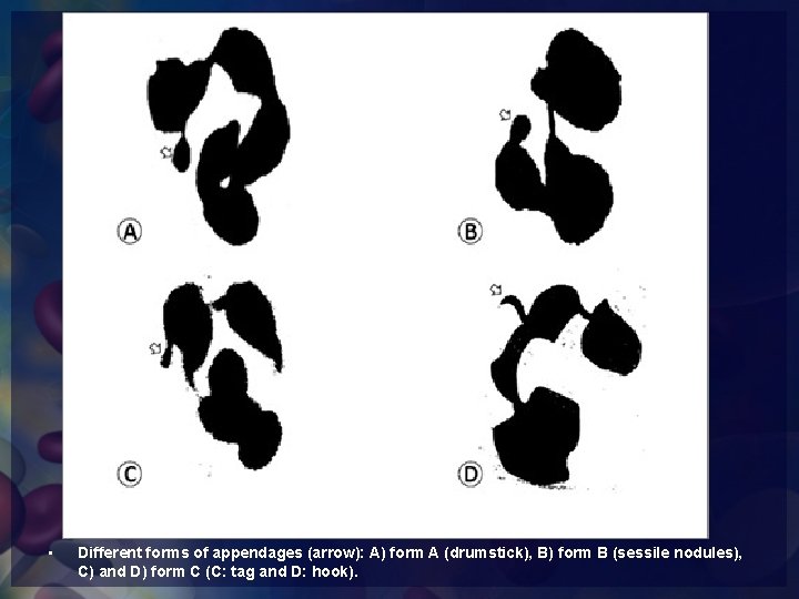  • Different forms of appendages (arrow): A) form A (drumstick), B) form B