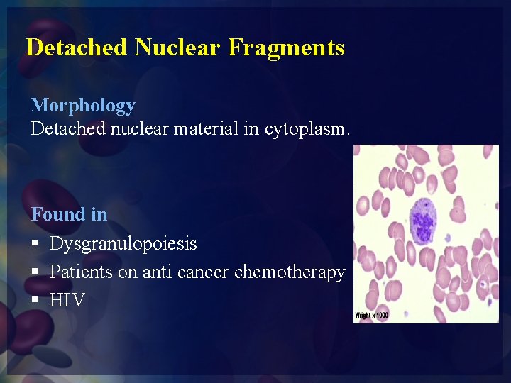 Detached Nuclear Fragments Morphology Detached nuclear material in cytoplasm. Found in § Dysgranulopoiesis §