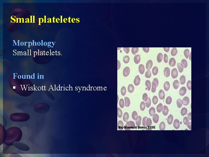 Small plateletes Morphology Small platelets. Found in § Wiskott Aldrich syndrome 