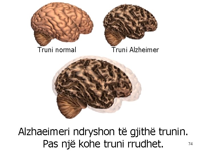 Truni normal Truni Alzheimer Alzhaeimeri ndryshon të gjithë trunin. Pas një kohe truni rrudhet.