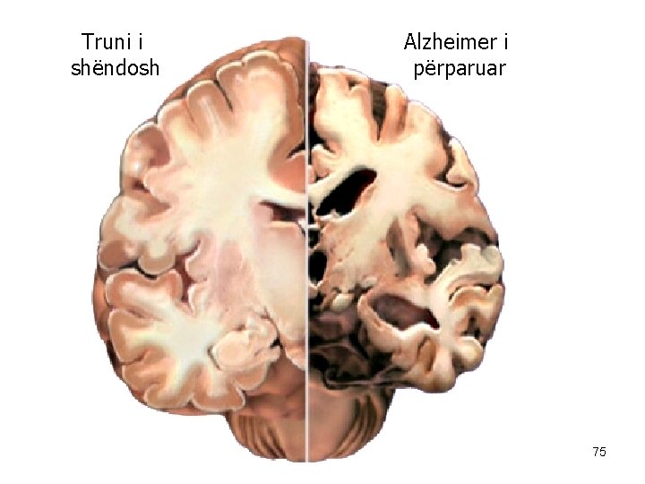 Truni i shëndosh Alzheimer i përparuar 75 