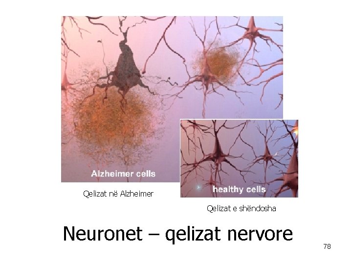 Qelizat në Alzheimer Qelizat e shëndosha Neuronet – qelizat nervore 78 