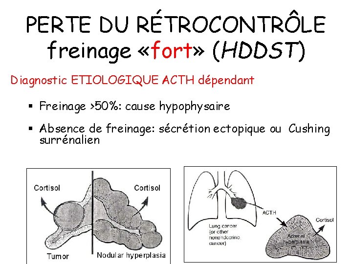 PERTE DU RÉTROCONTRÔLE freinage «fort» (HDDST) Diagnostic ETIOLOGIQUE ACTH dépendant § Freinage >50%: cause