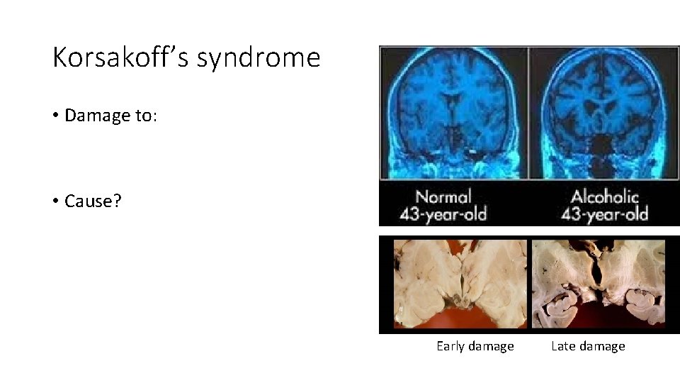 Korsakoff’s syndrome • Damage to: • Cause? Early damage Late damage 