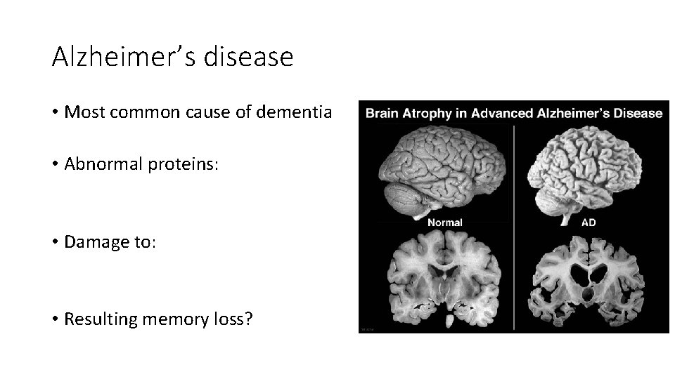 Alzheimer’s disease • Most common cause of dementia • Abnormal proteins: • Damage to: