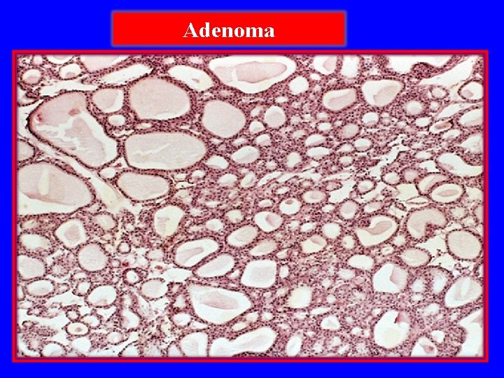 Adenoma 