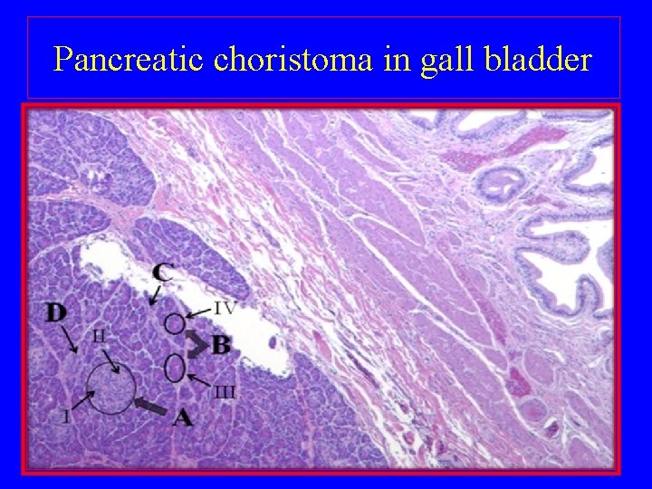 Pancreatic choristoma in gall bladder 