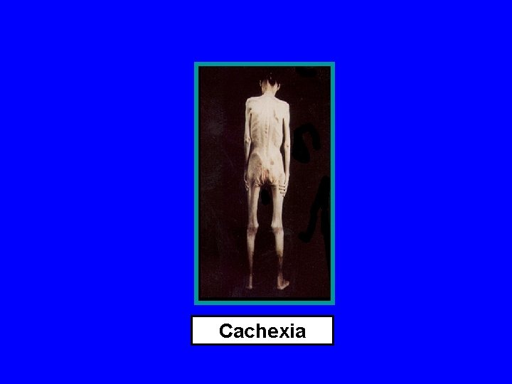 Cachexia 