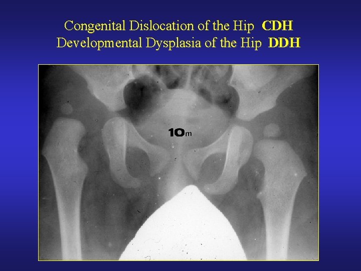 Congenital Dislocation of the Hip CDH Developmental Dysplasia of the Hip DDH 