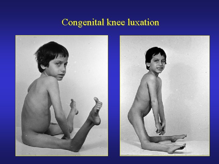 Congenital knee luxation 