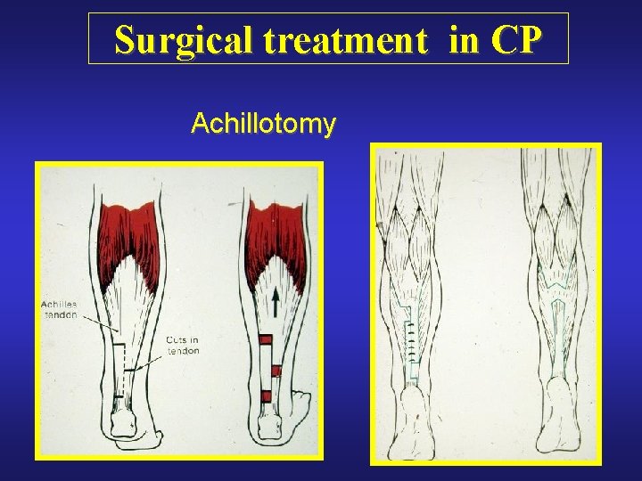 Surgical treatment in CP Achillotomy 