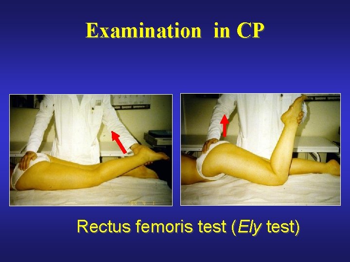 Examination in CP Rectus femoris test (Ely test) 