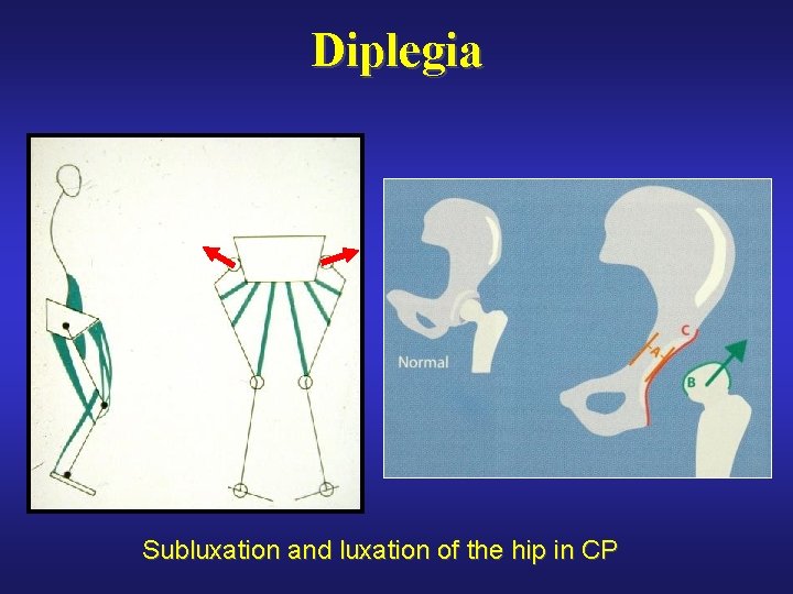 Diplegia Subluxation and luxation of the hip in CP 