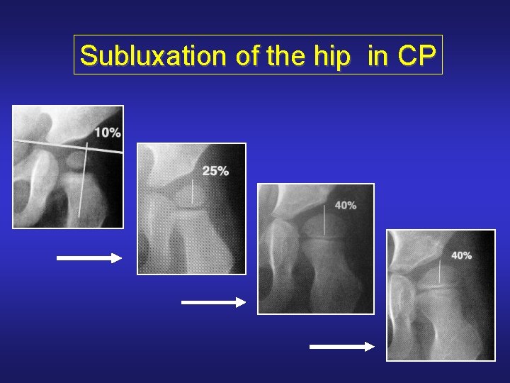 Subluxation of the hip in CP 