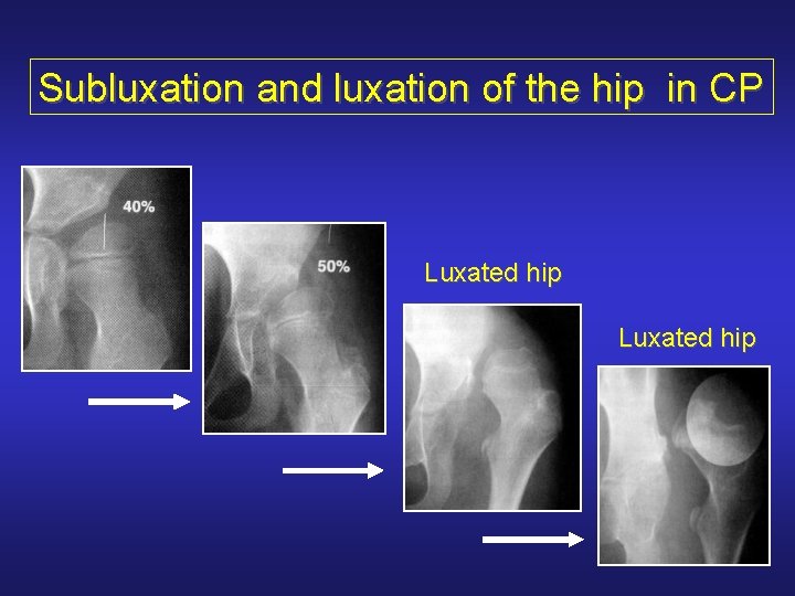 Subluxation and luxation of the hip in CP Luxated hip 