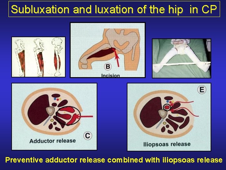 Subluxation and luxation of the hip in CP Preventive adductor release combined with iliopsoas