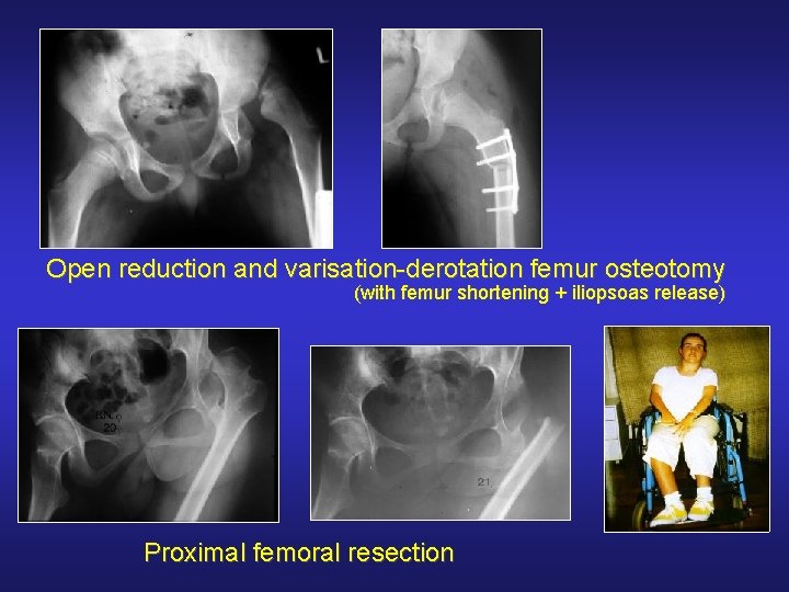 Open reduction and varisation-derotation femur osteotomy (with femur shortening + iliopsoas release) Proximal femoral