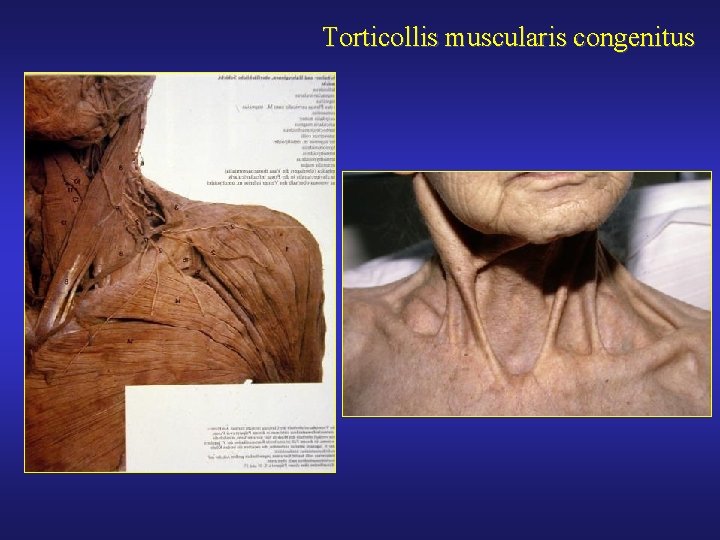 Torticollis muscularis congenitus 