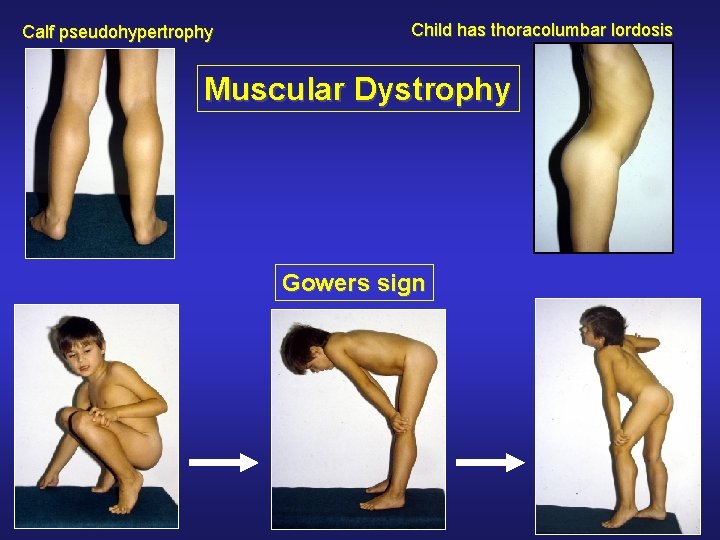 Calf pseudohypertrophy Child has thoracolumbar lordosis Muscular Dystrophy Gowers sign 