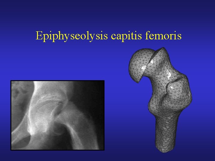 Epiphyseolysis capitis femoris 