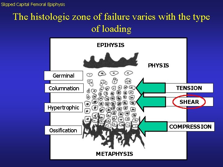 Slipped Capital Femoral Epiphysis The histologic zone of failure varies with the type of