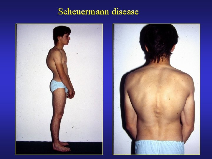 Scheuermann disease 