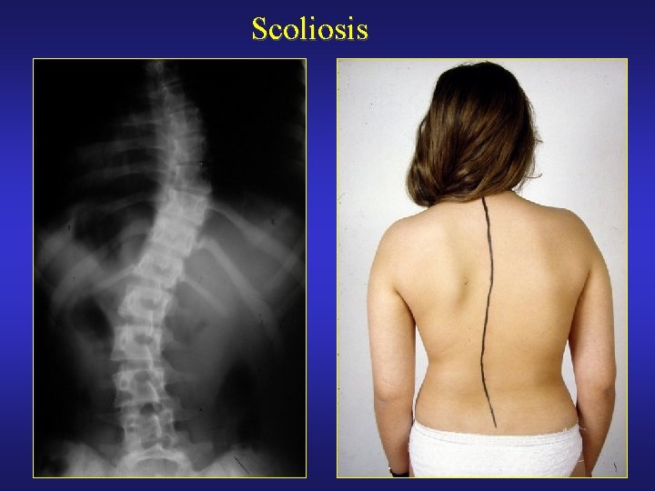 Scoliosis 