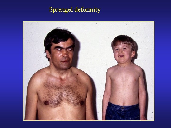 Sprengel deformity 