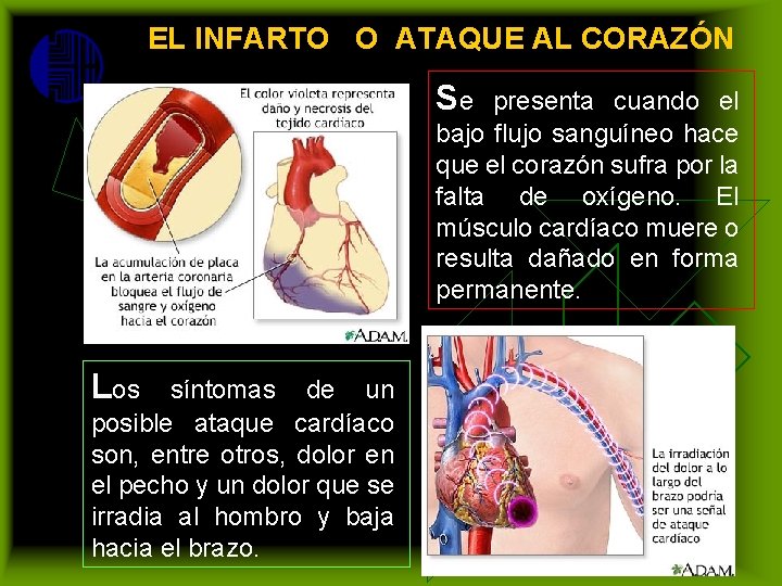 EL INFARTO O ATAQUE AL CORAZÓN Se presenta cuando el bajo flujo sanguíneo hace