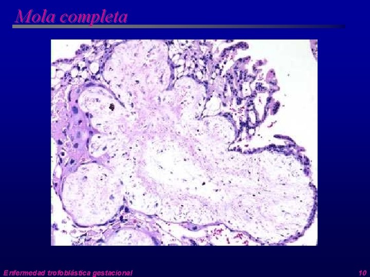 Mola completa Enfermedad trofoblástica gestacional 10 