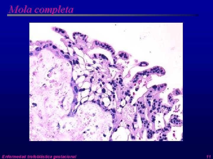 Mola completa Enfermedad trofoblástica gestacional 11 