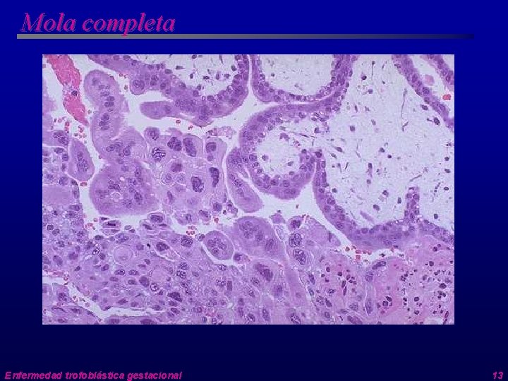 Mola completa Enfermedad trofoblástica gestacional 13 