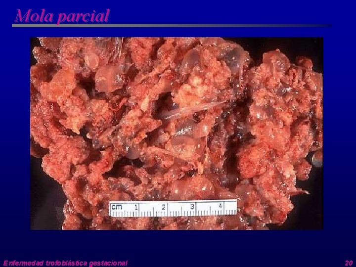 Mola parcial Enfermedad trofoblástica gestacional 20 