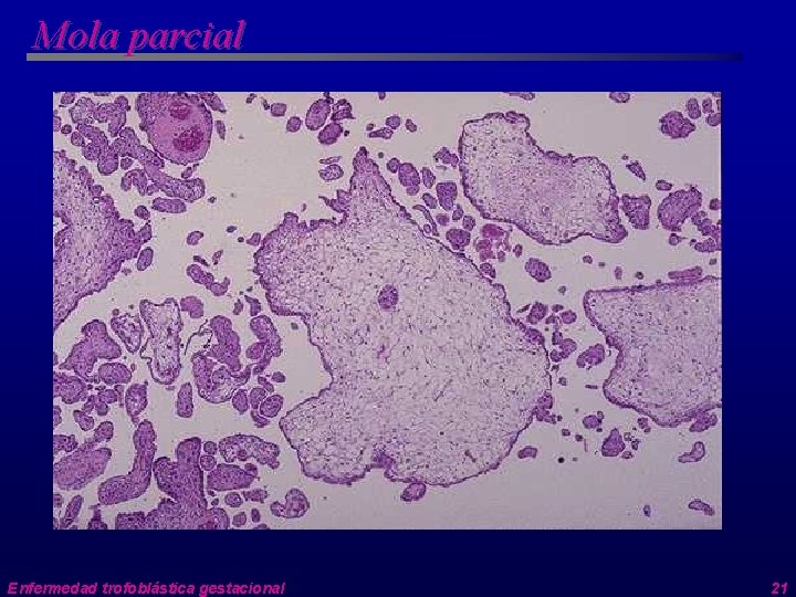 Mola parcial Enfermedad trofoblástica gestacional 21 