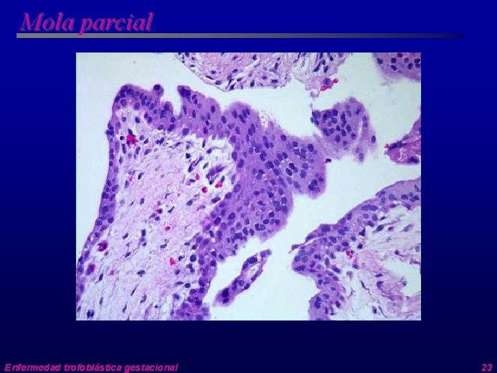 Mola parcial Enfermedad trofoblástica gestacional 23 