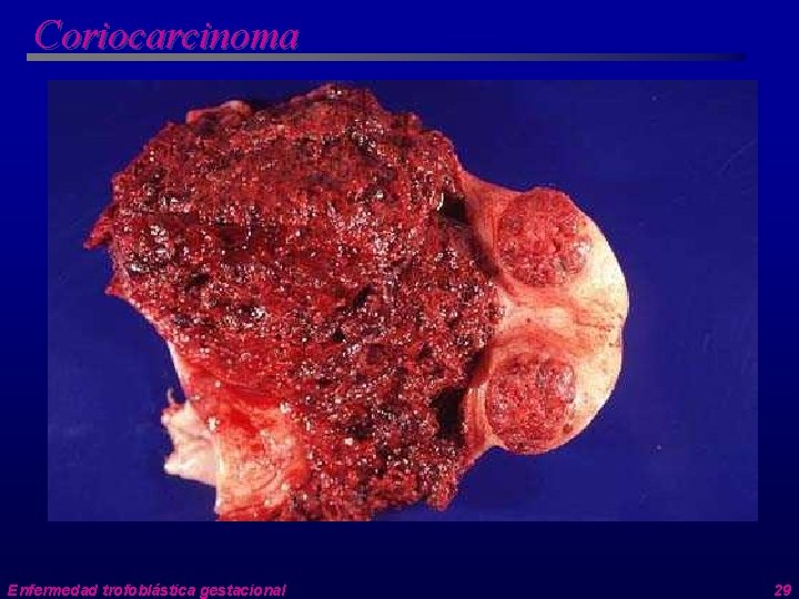 Coriocarcinoma Enfermedad trofoblástica gestacional 29 