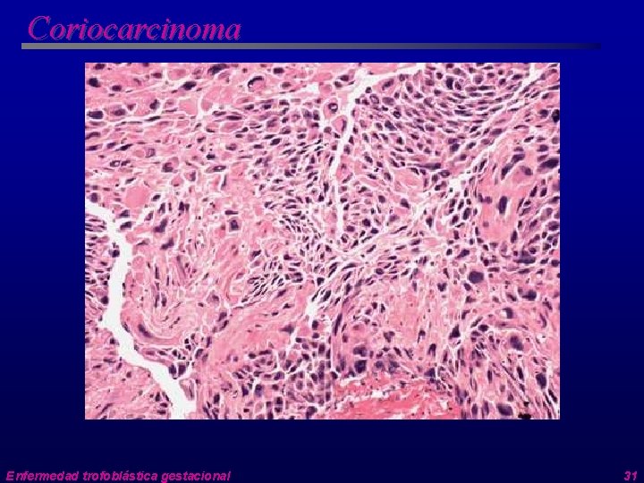 Coriocarcinoma Enfermedad trofoblástica gestacional 31 