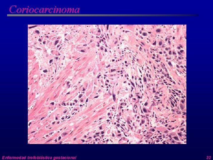 Coriocarcinoma Enfermedad trofoblástica gestacional 32 