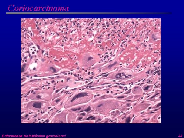 Coriocarcinoma Enfermedad trofoblástica gestacional 33 