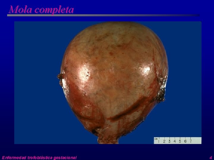 Mola completa Enfermedad trofoblástica gestacional 4 