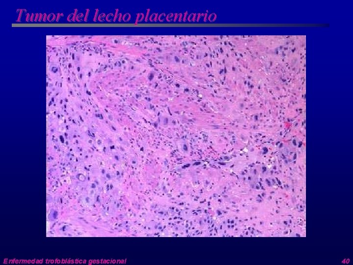 Tumor del lecho placentario Enfermedad trofoblástica gestacional 40 