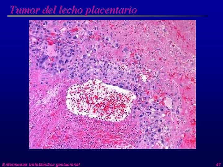Tumor del lecho placentario Enfermedad trofoblástica gestacional 41 