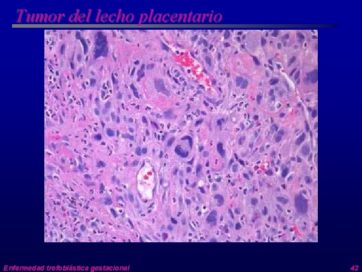 Tumor del lecho placentario Enfermedad trofoblástica gestacional 42 