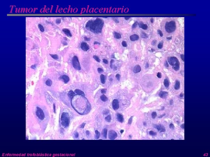 Tumor del lecho placentario Enfermedad trofoblástica gestacional 43 